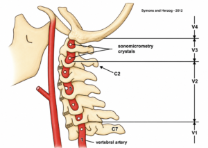 Chiropractic and Vertebral Artery Strain